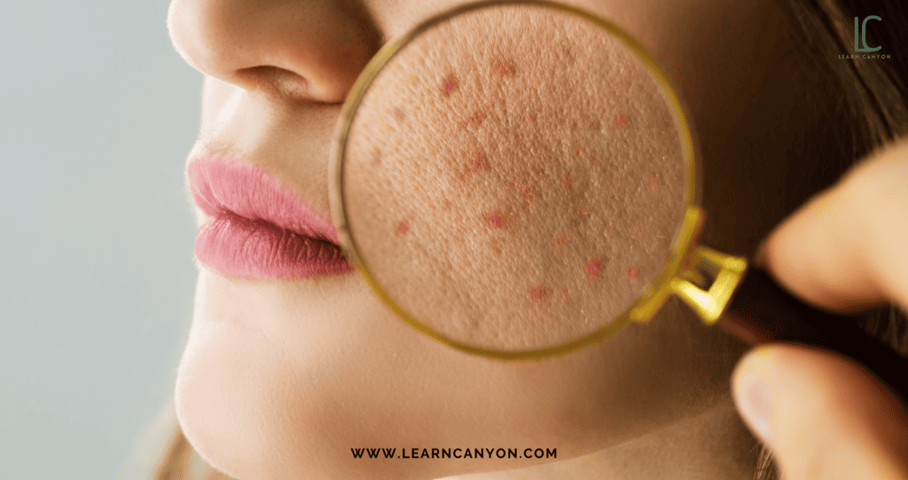Factors that can cause andor contribute to acne are