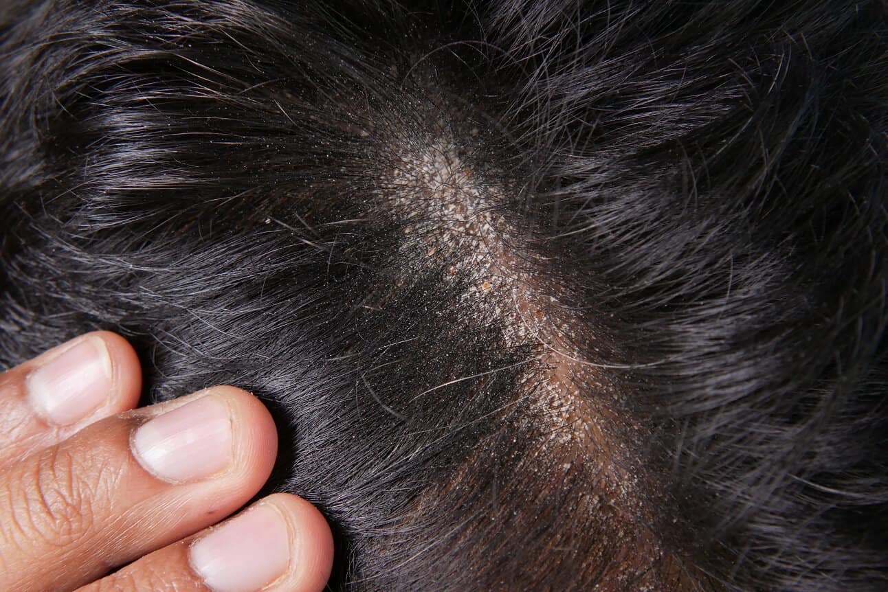 Oily scalp persona
